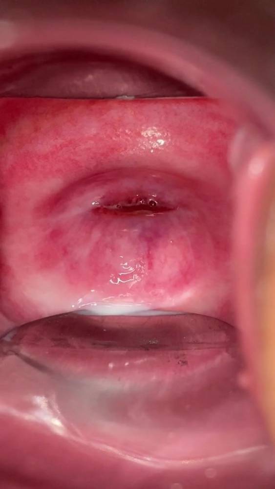 cervix - xh.video - Japan